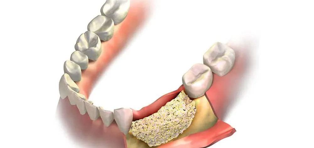 invisalign