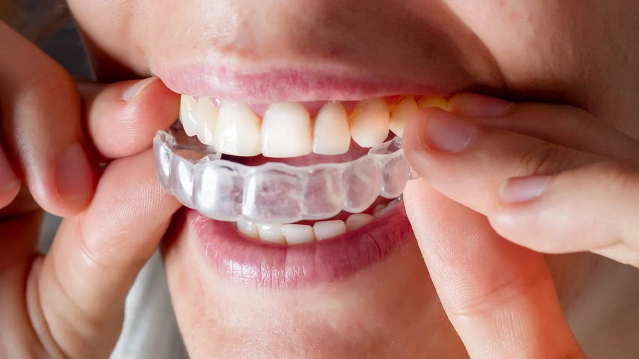 invisalign